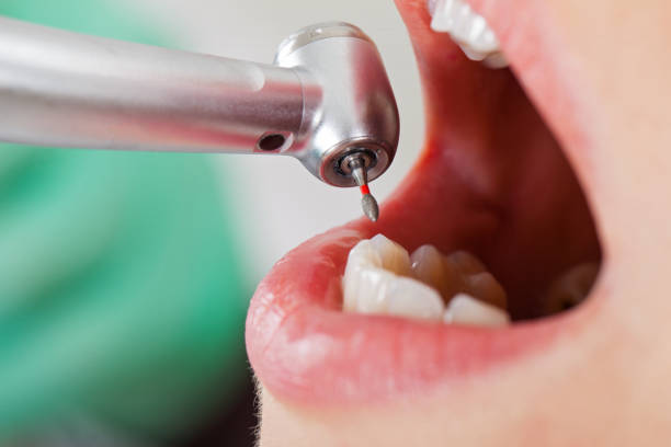 Best Emergency Wisdom Teeth Removal in Bay Point, CA